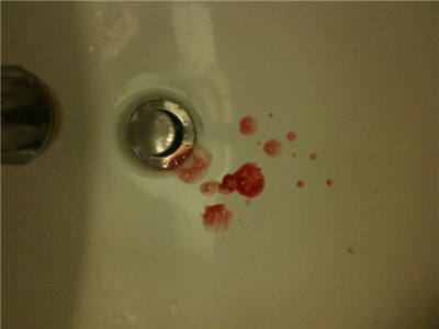 blood in saliva and sore throat