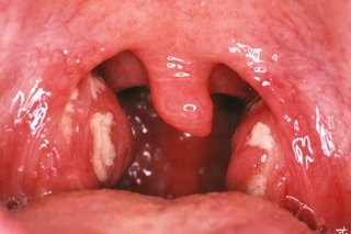 Pus-filled spots on tonsils in the back of the mouth.