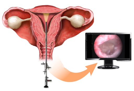 Гистероскопия матки