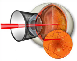 Лазерная коагуляция сетчатки