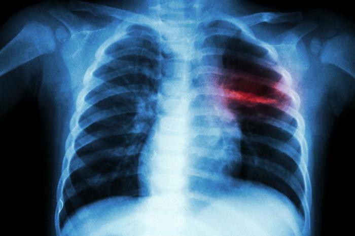 как происходит заражение туберкулезом 