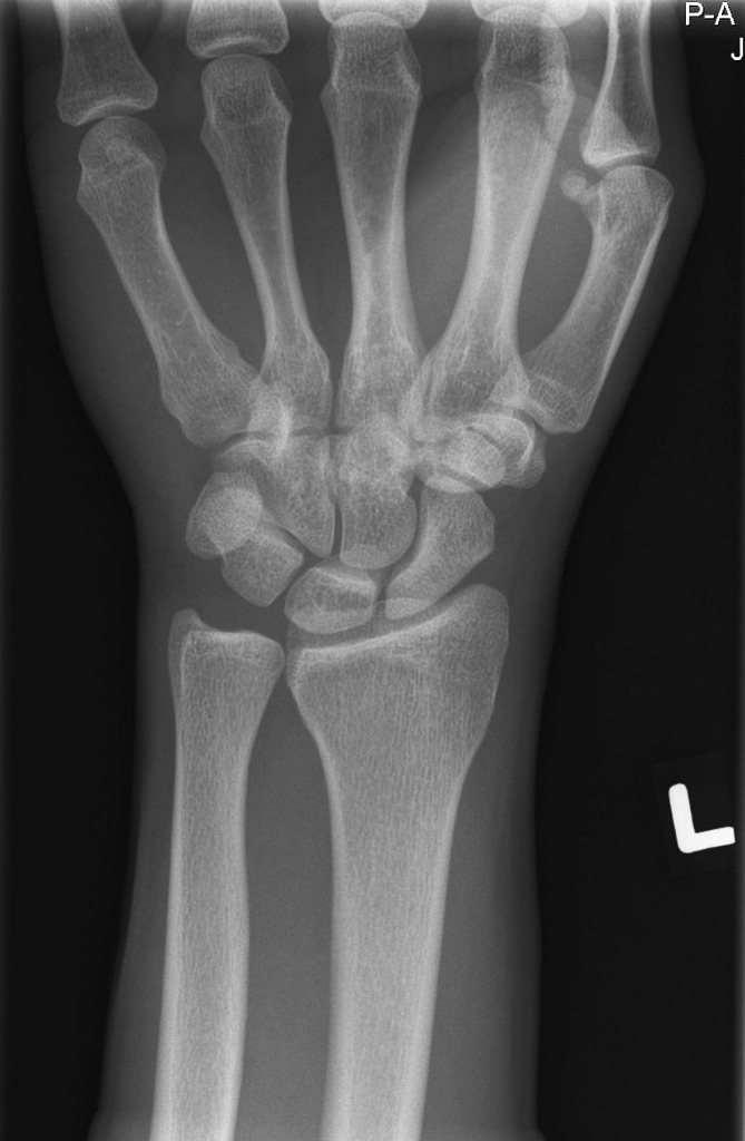 левый лучезапястный сустав рентген