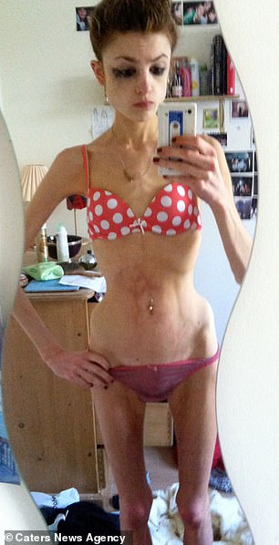 Lydia Davies, now 27, became anorexic after she got hooked on losing weight when she turned vegan in 2010