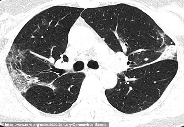 The CT scan of a 45-year-old woman from Sichuan Province in China who tested positive for COVID-19
