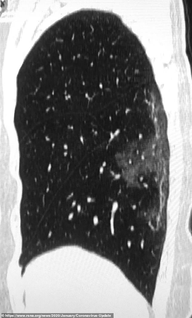 The scans show white patches in the lower corners of the lungs which indicates what radiologists call ground glass opacity - the partial filling of air spaces