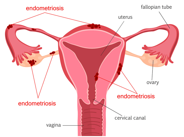 locations-endometriosis