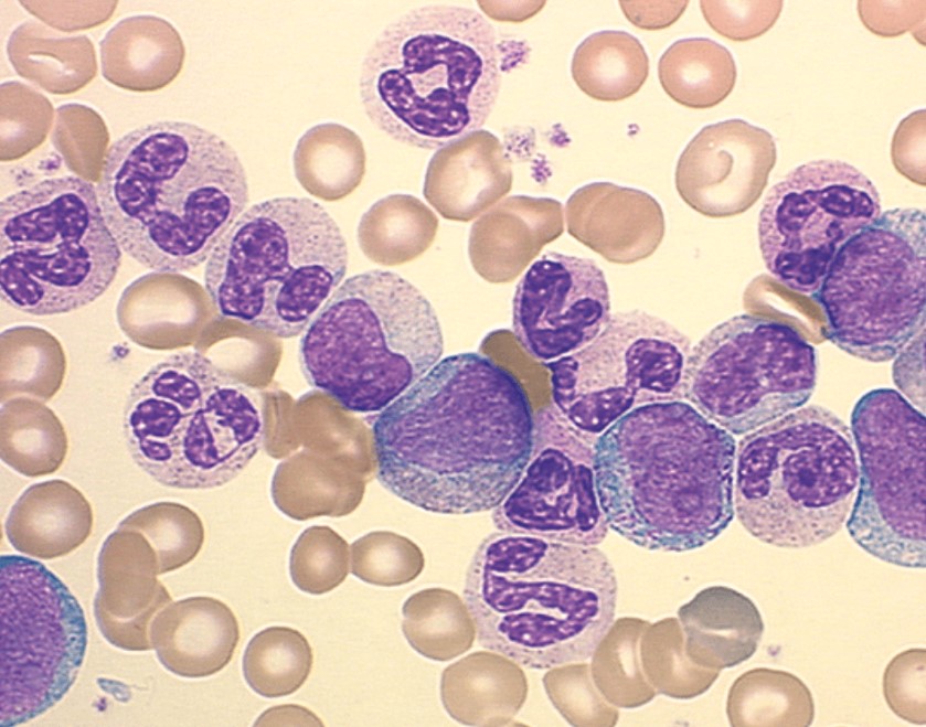 бластные клетки в анализе крови