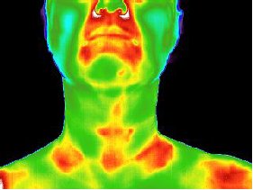 Термография щитовидной железы
