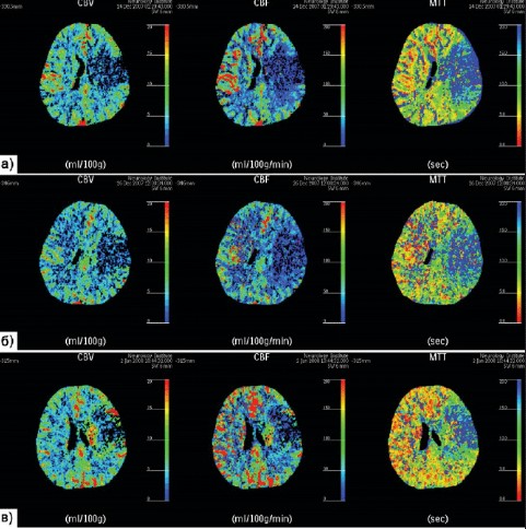 КТ перфузия головного мозга
