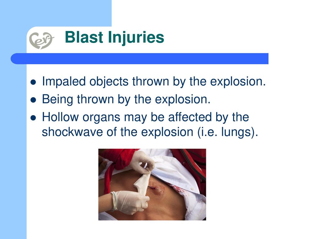 Blast Injuries Impaled objects thrown by the explosion.