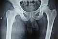 X-ray of soft tissue swelling of right thigh.jpg