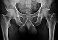 X-ray of hip osteoporosis.jpg