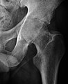 X-ray of septic arthritis of the hip.jpg