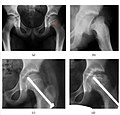 X-ray of epiphysiolysis progressing to osteonecrosis.jpg