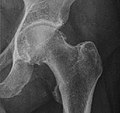 X-ray of coxa profunda.jpg