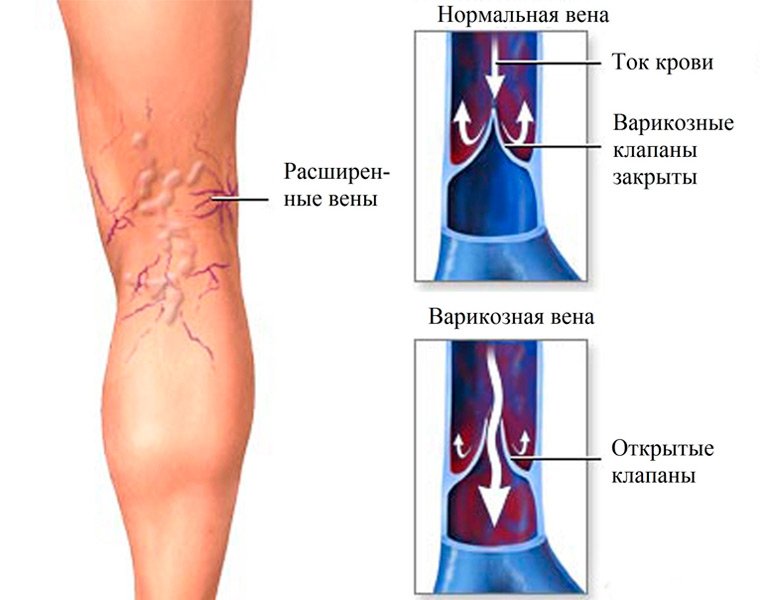 Какие болезни лечит флеболог