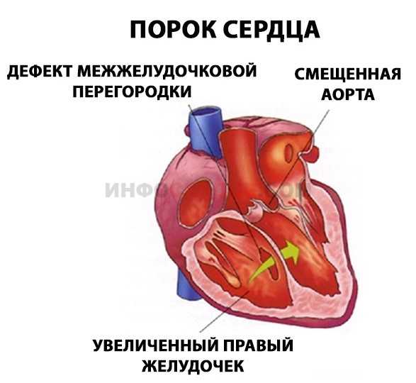 Проходят ли пороки сердца